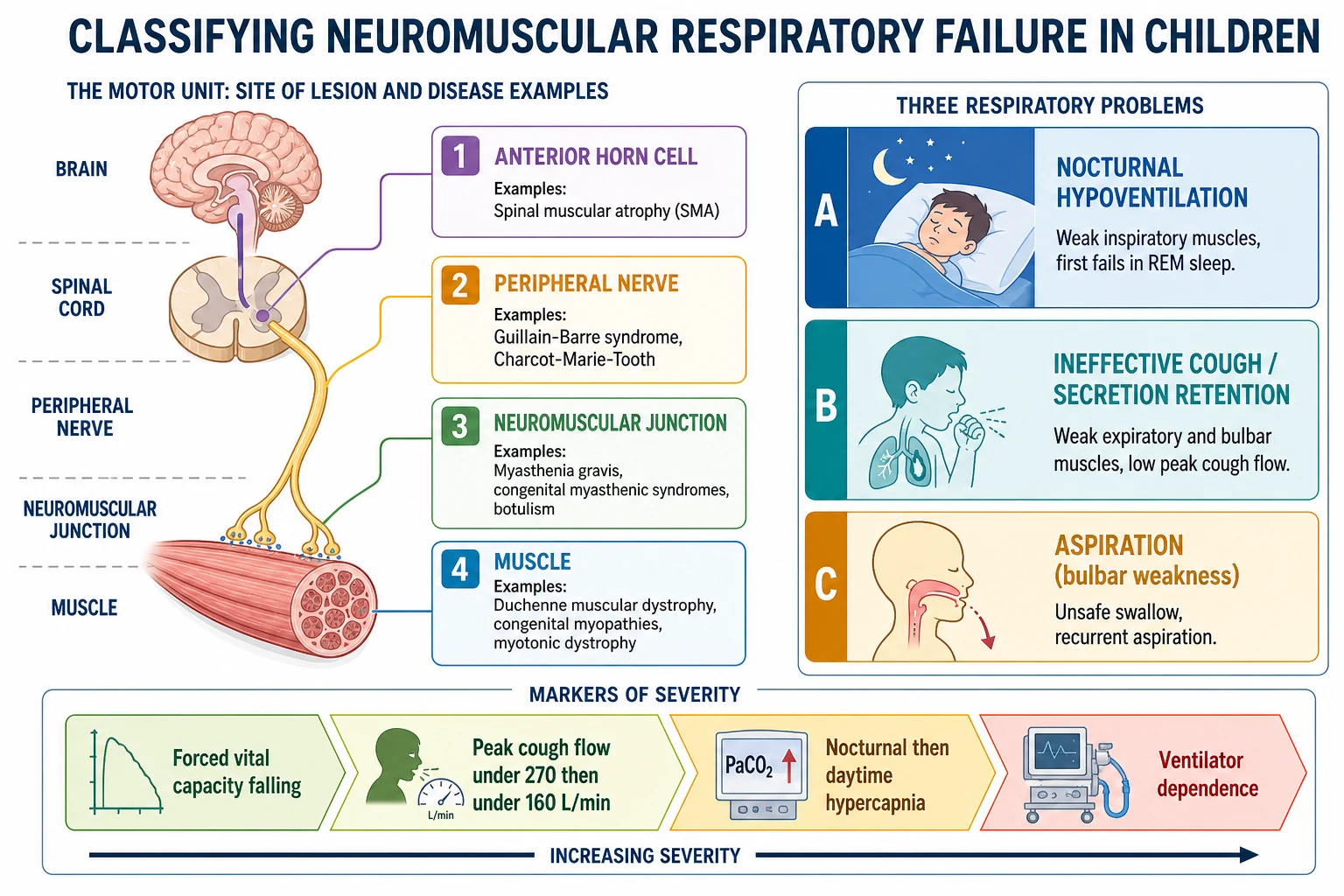 Classification of neuromuscular respiratory failure in children by lesion in the motor unit and by respiratory problem. Motor unit levels from anterior horn cell (spinal muscular atrophy), peripheral nerve (Guillain-Barre syndrome, Charcot-Marie-Tooth), neuromuscular junction (myasthenia gravis, congenital myasthenic syndromes, botulism) to muscle (Duchenne muscular dystrophy, congenital myopathies, myotonic dystrophy). Three respiratory problems: nocturnal hypoventilation from weak inspiratory muscles that first fails in rapid eye movement sleep, ineffective cough and secretion retention from weak expiratory and bulbar muscles with low peak cough flow, and aspiration from bulbar weakness with an unsafe swallow. A severity ladder runs from falling forced vital capacity, through peak cough flow under 270 then under 160 litres per minute, to nocturnal then daytime hypercapnia and ventilator dependence.