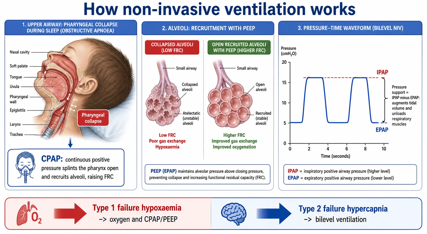 Physiology diagram of how non-invasive ventilation works. On the left, a sagittal section of a child upper airway shows pharyngeal collapse during sleep, with CPAP splinting it open and recruiting alveoli to raise functional residual capacity. In the middle, two alveoli are compared, one collapsed and one recruited and open under PEEP. On the right, a pressure-versus-time waveform shows a higher plateau labelled IPAP and a lower baseline labelled EPAP, with the difference bracketed as pressure support that augments tidal volume and unloads respiratory muscles. A bottom banner shows type 1 hypoxaemic failure treated with oxygen and CPAP or PEEP, and type 2 hypercapnic failure treated with bilevel ventilation.