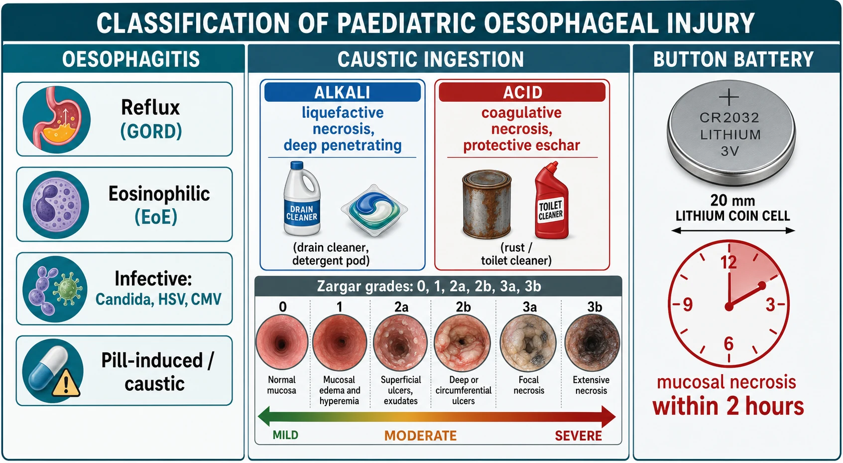Classification chart of paediatric oesophageal injury with three columns: oesophagitis (reflux, eosinophilic, infective, pill or caustic), caustic ingestion contrasting alkali liquefactive necrosis with acid coagulative necrosis and the Zargar endoscopic grades 0 to 3b, and the button battery as a 20 mm lithium coin cell causing mucosal necrosis within two hours