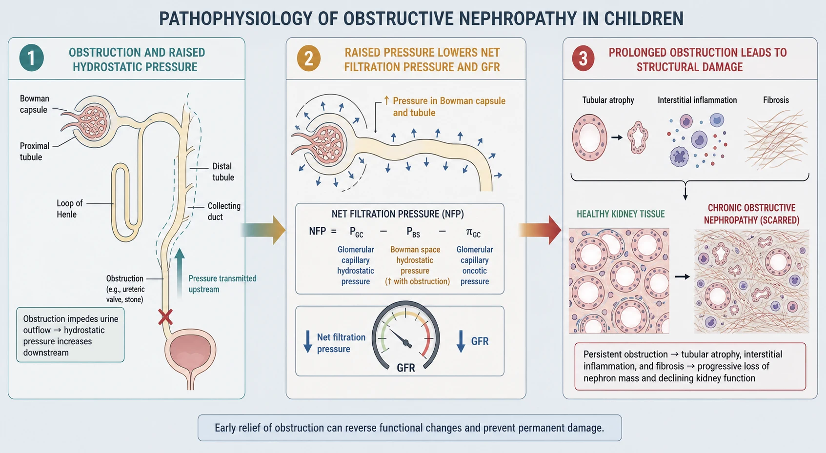 A left-to-right scientific schematic of obstructive nephropathy on a pale slate background, beginning with a stylised nephron line diagram showing an obstruction raising downstream hydrostatic pressure, progressing to a central stage where raised intratubular and Bowman capsule pressure lowers net filtration pressure and glomerular filtration rate shown with downward arrows and a falling gauge, and ending on the right with prolonged obstruction causing tubular atrophy, interstitial inflammation, and fibrosis drawn as a transition from healthy tissue to scarred fibrous tissue, connected by gradient arrows from teal to amber to red.