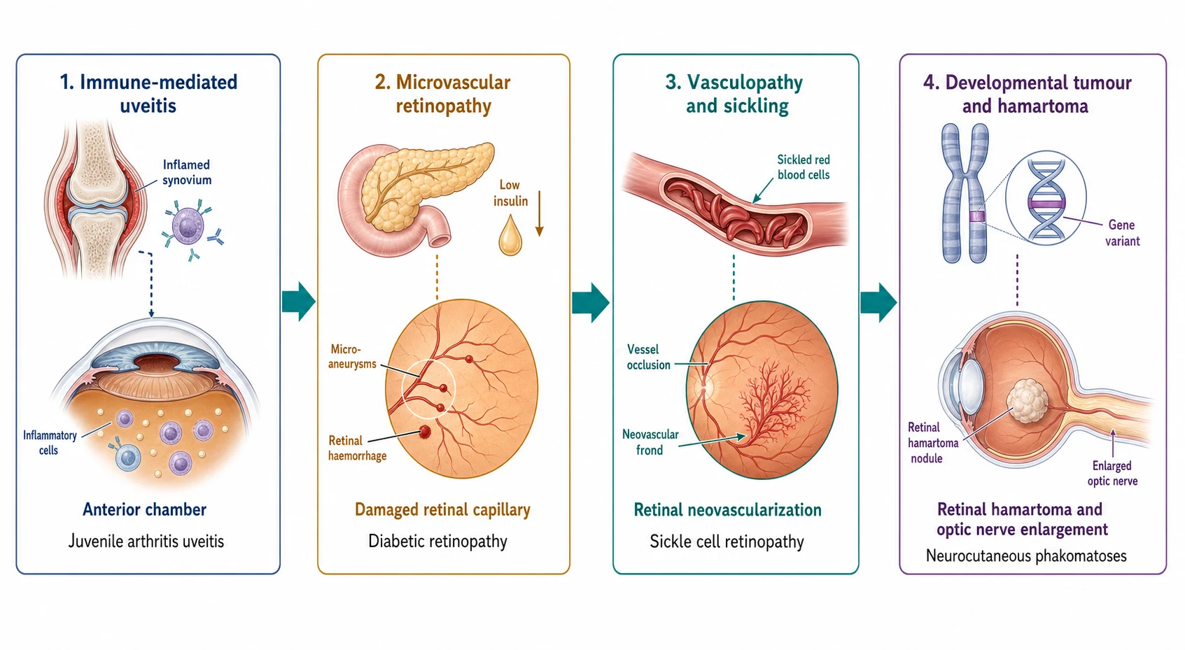 A clean scientific schematic on a white background in landscape flowing left to right in four connected panels joined by teal arrows. Panel one in a slate-blue border shows an inflamed joint with red synovium linked by a dotted line to an eye anterior chamber with floating inflammatory cells. Panel two in a soft-amber border shows a pancreas with low insulin linked to a damaged retinal capillary with microaneurysms and a haemorrhage dot. Panel three in a teal border shows crescent sickled red cells blocking a retinal vessel with a neovascular frond. Panel four in a purple border shows a chromosome with a highlighted gene linked to a retinal hamartoma nodule and an enlarged optic nerve.