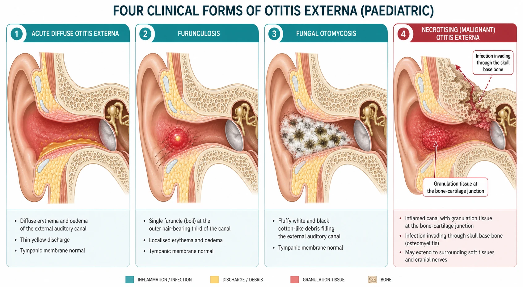 Four-panel cross-section schematic of paediatric otitis externa: acute diffuse swimmer's ear with a swollen red canal, thin yellow discharge and a normal eardrum; furunculosis with a single red boil at the outer hair-bearing third; fungal otomycosis with fluffy white and black cotton-like canal debris; and necrotising otitis externa with granulation tissue at the bony-cartilaginous junction invading through the skull base bone.