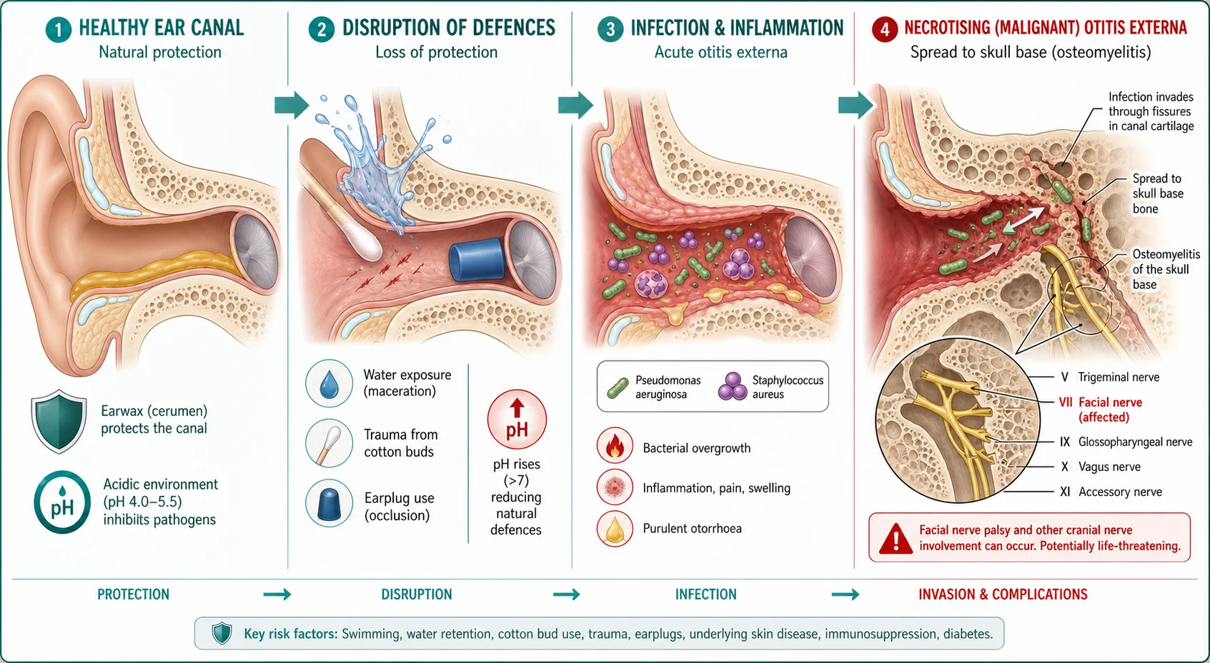 Left-to-right pathophysiology cascade: a healthy canal protected by an acidic golden cerumen layer with a shield; then water splashing in, a cotton bud scratching the skin and an earplug occluding it, with the cerumen lost and pH rising; then green rod-shaped Pseudomonas and purple Staphylococcus multiplying on the vulnerable skin with inflammation and pus; and finally the necrotising pathway of Pseudomonas invading through cartilage fissures into the skull-base bone, with the cranial nerves, especially the facial nerve, highlighted.