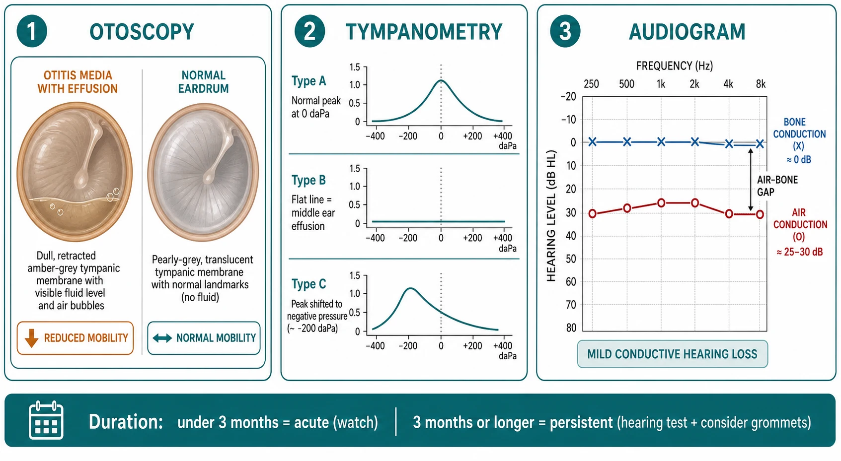 Three-panel diagnostic schematic showing otoscopy findings of OME (dull retracted amber drum with fluid level and bubbles beside a normal pearly-grey drum), the three tympanogram traces (type A normal peak, type B flat effusion, type C negative pressure) and an audiogram demonstrating a mild conductive hearing loss with an air-bone gap, plus a duration bar separating acute OME under three months from persistent OME three months or longer.