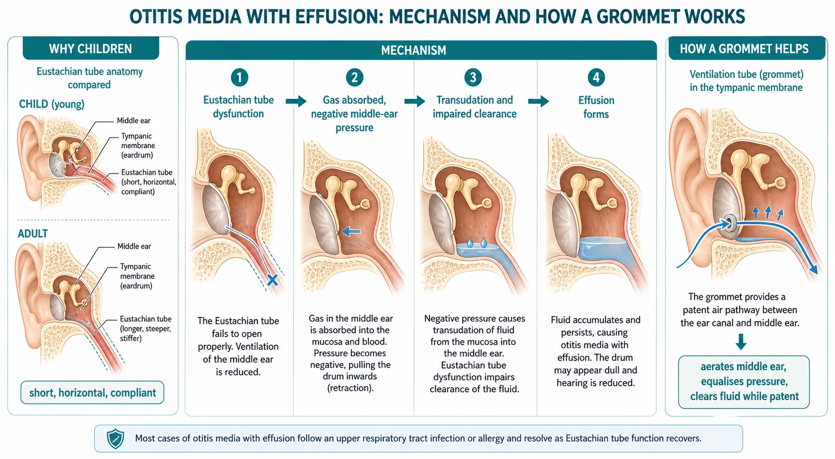 Mechanism schematic contrasting the short, horizontal, compliant paediatric Eustachian tube with the longer, steeper adult tube, followed by a four-step flow (Eustachian tube dysfunction leading to gas absorption and negative middle-ear pressure, then transudation and impaired clearance, then effusion), and a grommet shown in the tympanic membrane providing an air pathway that aerates the middle ear and equalises pressure.