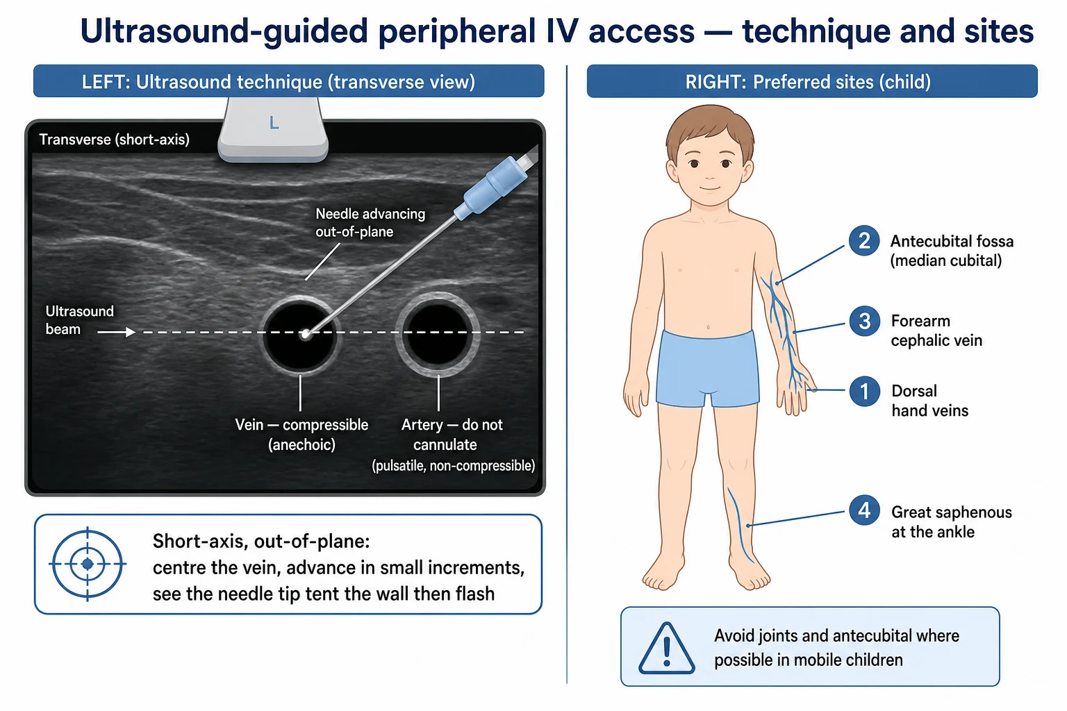 A short-axis out-of-plane ultrasound view showing a compressible anechoic vein centred beside a non-compressible artery, and a labelled surface map of the arm ranking the preferred cannulation sites 1 to 4
