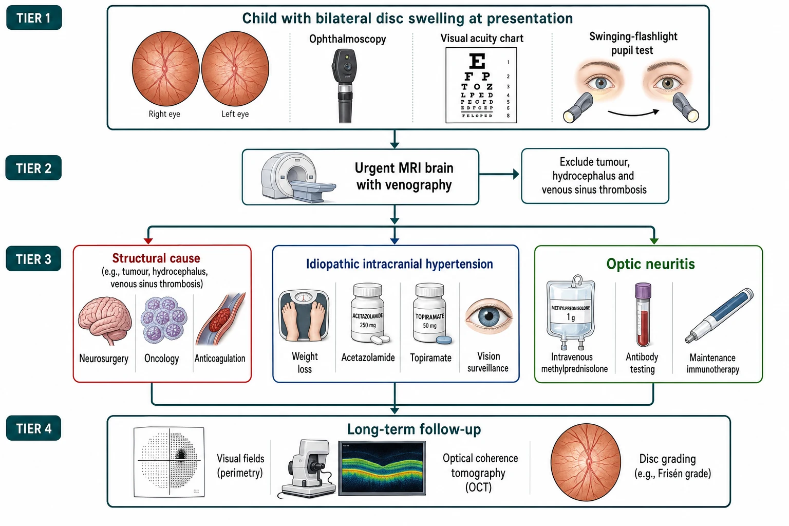 A clean medical flowchart on a white background in landscape flowing top to bottom in four tiers connected by teal arrows. The top tier shows a child with the bilateral disc swelling at the presentation, with icons for the fundoscope, the visual acuity chart and the swinging-flashlight pupil test. The second tier is an urgent arrow to the magnetic resonance imaging with the venography, with a branch labelled exclude the tumour and the hydrocephalus and the venous sinus thrombosis. The third tier splits into three parallel paths. The left path in red for the structural cause shows the neurosurgery or the oncology or the anticoagulation. The middle path in blue for the idiopathic intracranial hypertension shows the weight loss and the acetazolamide and the topiramate and the surveillance. The right path in green for the optic neuritis shows the intravenous methylprednisolone and the antibody testing and the maintenance immunotherapy. The bottom tier shows the long-term follow-up with the visual fields and the optical coherence tomography and the disc grading. Clean medical flat illustration, crisp labels, no photographic faces, no spelling errors, generous whitespace, professional.