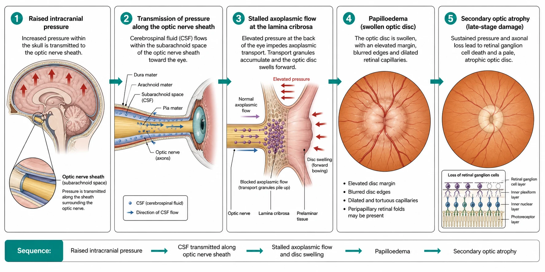 A clean scientific schematic on a white background in landscape flowing left to right in five connected boxes joined by teal arrows. The first box shows the brain in cross-section with the raised intracranial pressure indicated by upward red arrows and an ocular nerve sheath highlighted. The second box shows the optic nerve in longitudinal section wrapped in the meninges, with the cerebrospinal fluid of the subarachnoid space flowing along the sheath from the brain toward the eye, drawn as small blue dots. The third box shows the prelaminar tissue at the back of the eye, with the stalled axoplasmic flow drawn as blocked transport granules piling up and the disc beginning to swell forward. The fourth box shows the swollen optic disc in cross-section with the elevated margin, the blurred edges and the dilated capillaries, labelled papilloedema. The fifth box shows the late-stage damage with the pale atrophic disc and the lost retinal ganglion cells, labelled secondary optic atrophy. Clean medical flat illustration, crisp labels, no photographic faces, no spelling errors, professional.