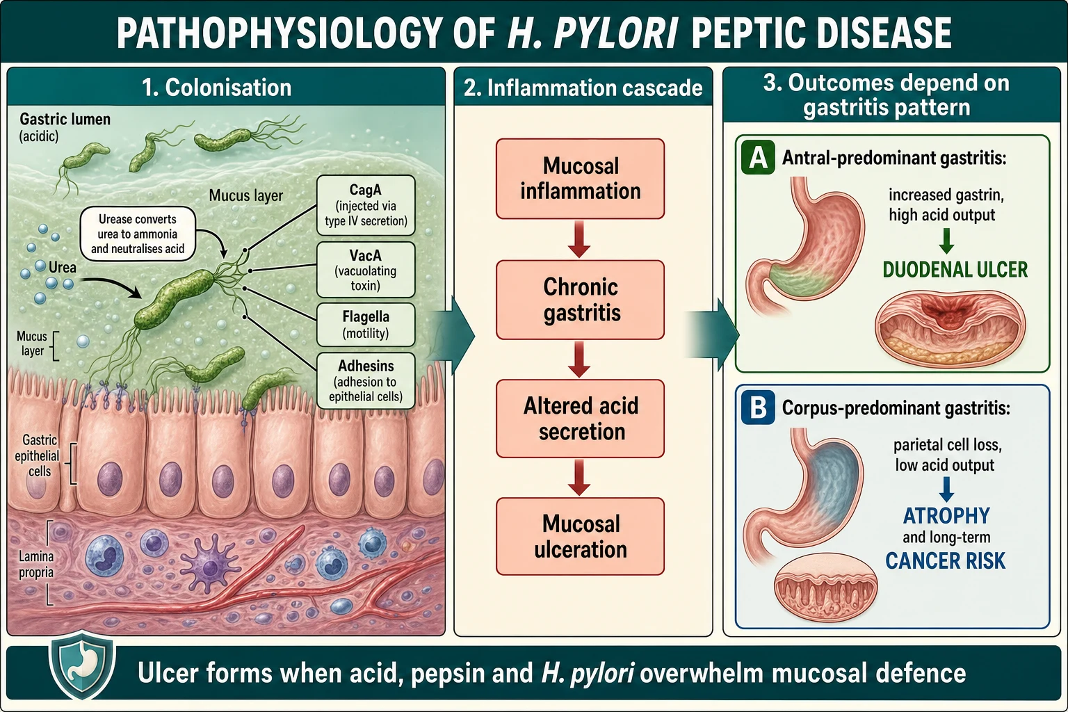 Mechanism diagram showing H. pylori urease, CagA and VacA virulence factors driving mucosal inflammation, with antral gastritis leading to high acid and duodenal ulcer and corpus gastritis leading to atrophy