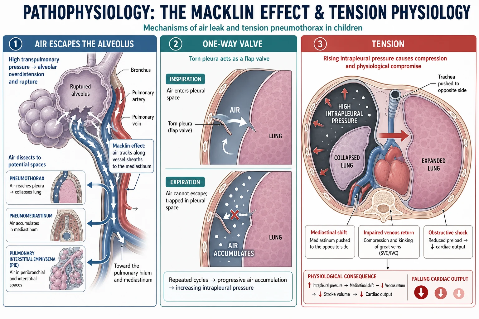Left panel showing an alveolus rupturing and air dissecting along vessel sheaths to the mediastinum, a centre panel showing a pleural flap acting as a one-way valve, and a right panel showing tension physiology with mediastinal shift and reduced venous return
