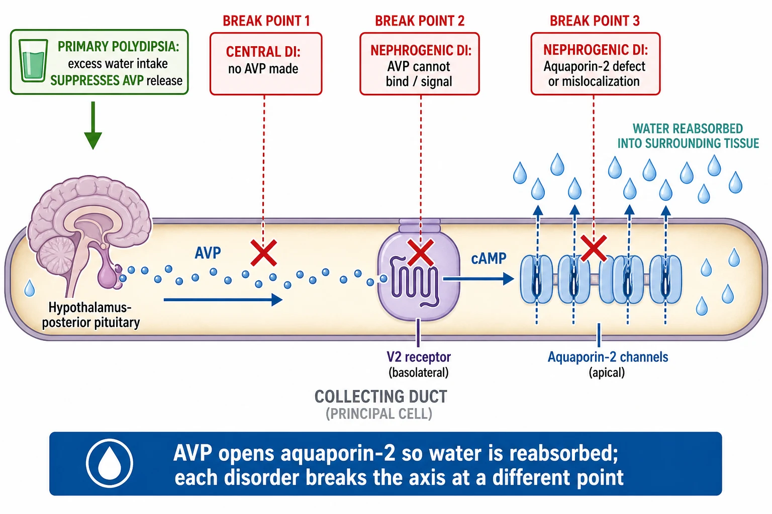 Horizontal mechanism diagram inside a stylised collecting duct tube on a white background. Left segment shows a hypothalamus and posterior pituitary icon releasing AVP dots travelling rightward. Middle segment shows the AVP dots binding a V2 receptor node on the duct wall with a cAMP arrow. Right segment shows aquaporin-2 channel gates opening so water droplets flow out of the duct into the tissue. Three break-point markers with red crosses show central DI as no AVP made, nephrogenic DI as AVP unable to bind or signal, and primary polydipsia as excess intake suppressing AVP release. A footer banner reads AVP opens aquaporin-2 so water is reabsorbed.
