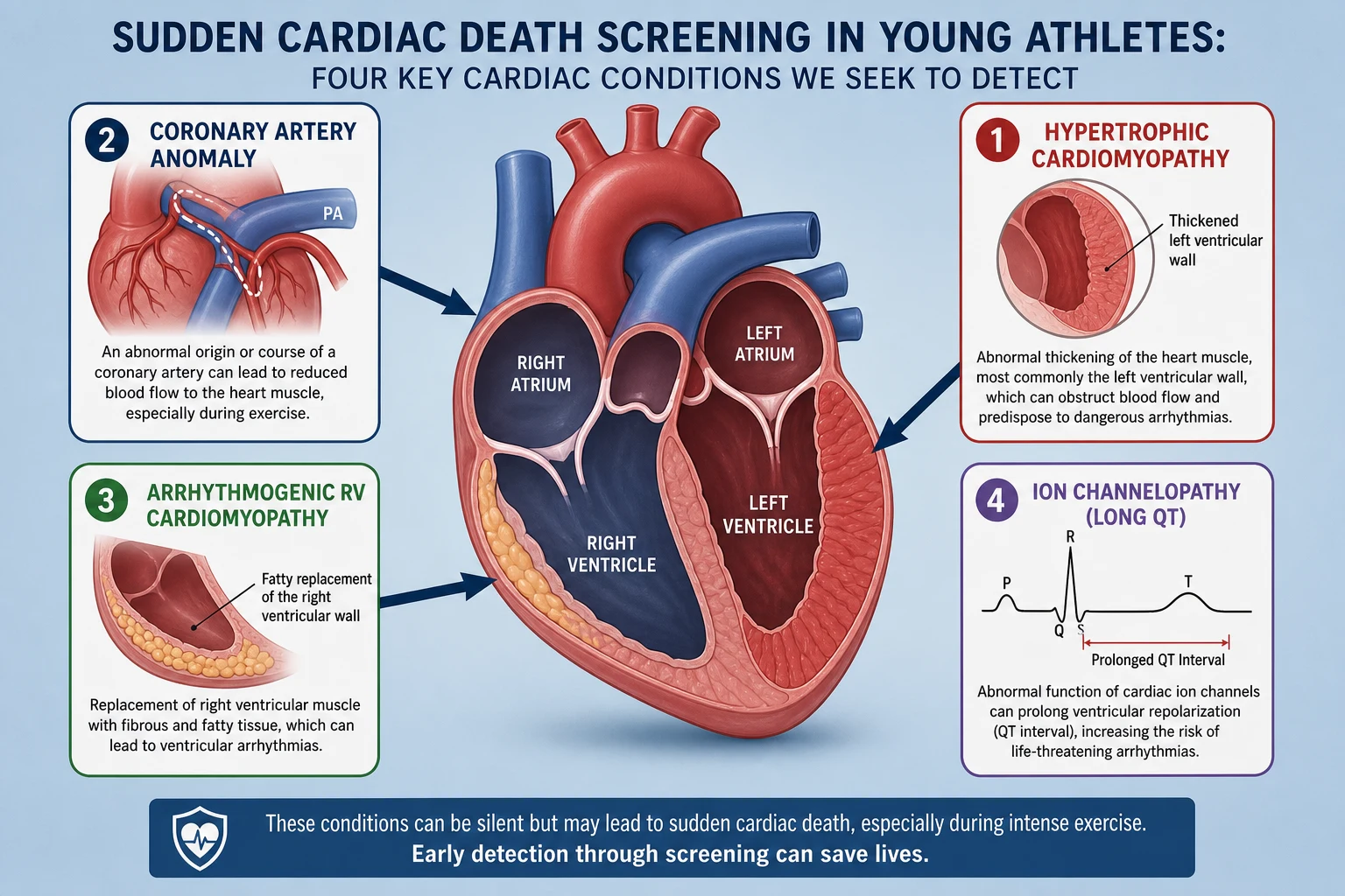 An educational schematic of a labelled heart cross-section showing four regions marked hypertrophic cardiomyopathy with a thickened left ventricular wall, coronary artery anomaly with an abnormal vessel course, arrhythmogenic right ventricular cardiomyopathy with fatty replacement of the wall, and ion channelopathy long QT with a small ECG trace showing a prolonged QT interval