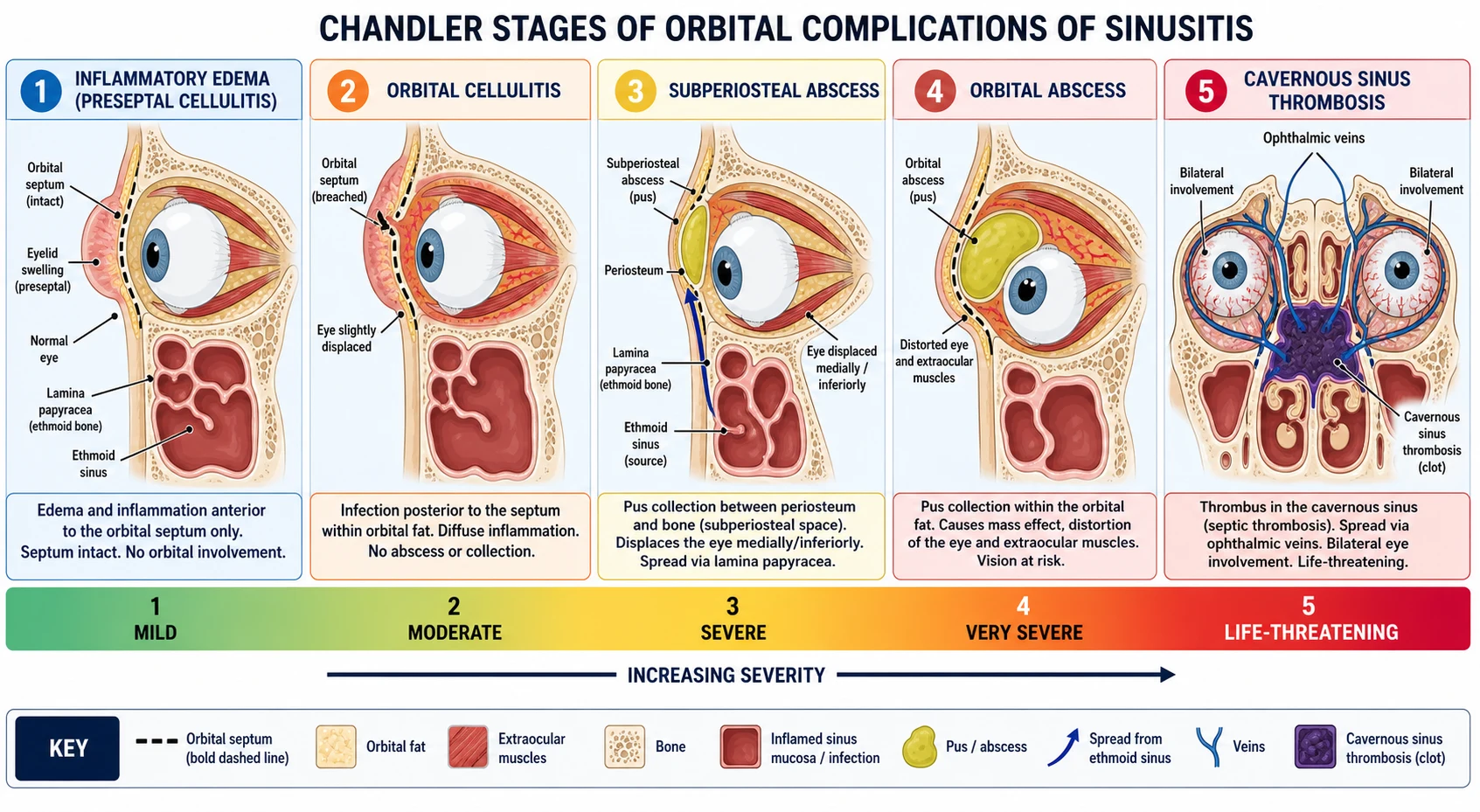Five-panel cross-section schematic of the orbit and ethmoid sinus showing the Chandler five-stage progression: stage 1 inflammatory eyelid oedema anterior to the intact septum; stage 2 orbital cellulitis with diffuse inflammation posterior to the septum; stage 3 subperiosteal abscess as a pus collection between the periosteum and the medial orbital wall with an arrow through the lamina papyracea; stage 4 orbital abscess within the orbital fat distorting the globe; stage 5 cavernous sinus thrombosis with clot at the back and bilateral involvement, with the orbital septum drawn as a consistent dashed line and a severity gradient bar from green to deep red