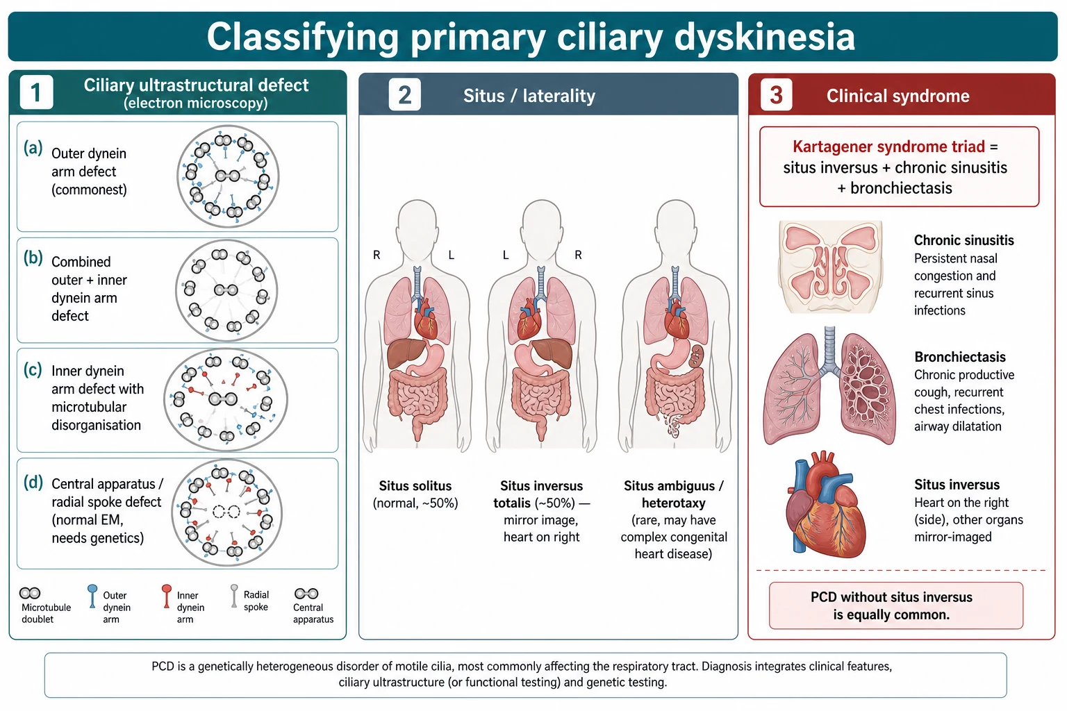 Classification of primary ciliary dyskinesia by ciliary ultrastructural defect on electron microscopy (outer dynein arm defect, combined outer and inner dynein arm defect, inner dynein arm defect with microtubular disorganisation, and central apparatus or radial spoke defect), by situs (situs solitus, situs inversus totalis, and situs ambiguus or heterotaxy), and by clinical syndrome including the Kartagener triad of situs inversus, chronic sinusitis and bronchiectasis
