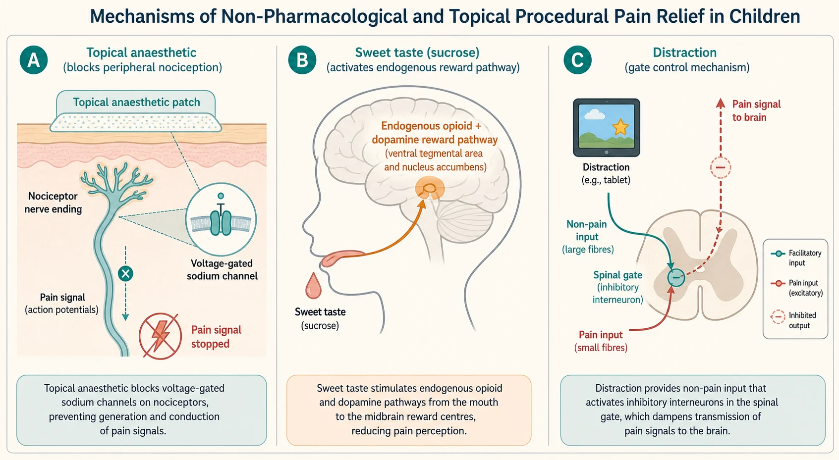 Schematic of three mechanisms: topical anaesthetic blocking a voltage-gated sodium channel in a skin nociceptor, sweet taste activating an endogenous opioid and dopamine reward pathway in the brain, and distraction modulating a spinal gate that dampens an ascending pain signal