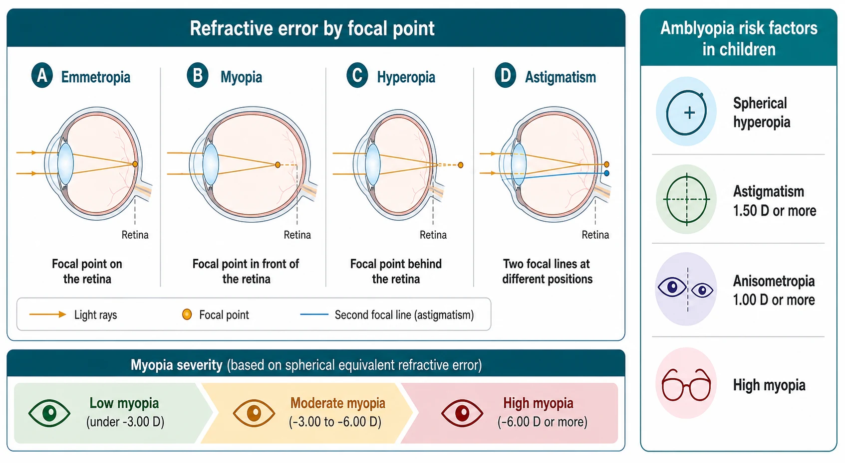 Classification schematic of refractive error by focal point: four labelled eye cross-sections side by side, emmetropia with light focusing on the retina, myopia with an elongated eye focusing light in front of the retina, hyperopia with a short eye focusing light behind the retina, and astigmatism with a distorted cornea producing two focal lines; below a horizontal myopia severity band split into low under minus 3.00 dioptres, moderate minus 3.00 to minus 6.00 dioptres and high minus 6.00 dioptres or more; and a side card of amblyopia risk factors listing significant hyperopia, astigmatism of 1.50 dioptres or more, anisometropia of 1.00 dioptre or more and high myopia