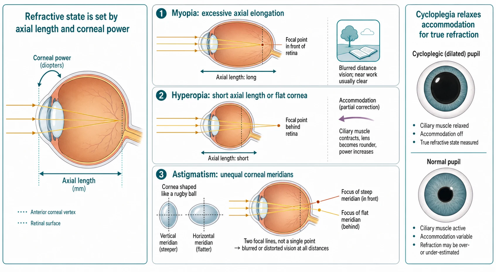 Pathophysiology schematic of refractive error: a labelled eye showing axial length measured from cornea to retina and corneal power as a curved arrow over the cornea, captioned refractive state is set by axial length and corneal power; beside it a three-row teaching ladder with myopia showing an elongated globe and light focusing in front of the retina, hyperopia showing a short globe and light focusing behind the retina with an accommodation arrow, and astigmatism showing an unequal corneal meridian producing two focal lines; and a small panel contrasting a cycloplegic dilated pupil with a normal pupil to show that cycloplegia relaxes accommodation for true refraction