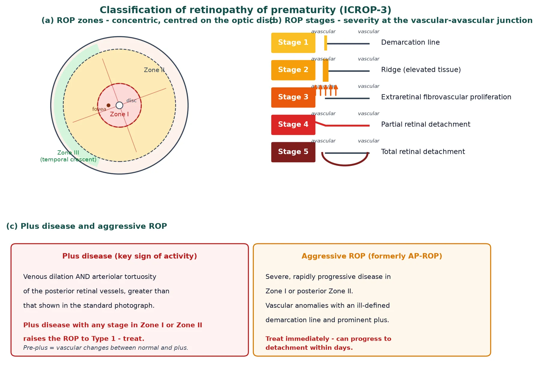 ICROP-3 classification of ROP showing the three disc-centred zones, the five stages at the vascular-avascular junction, plus and pre-plus disease, and aggressive ROP