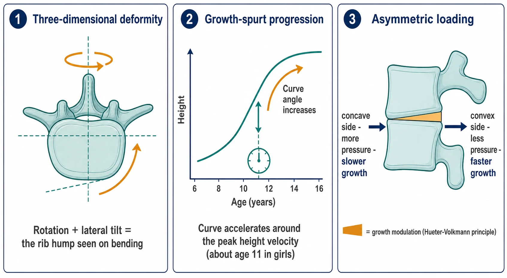 Three-panel teaching diagram. Panel one titled three-dimensional deformity shows a single vertebra viewed from above with a curved arrow indicating rotation around the vertical axis and a second arrow indicating lateral tilt, captioned rotation plus lateral tilt equals the rib hump seen on bending. Panel two titled growth-spurt progression shows a curve with a vertical growth arrow and an age axis, captioned the curve accelerates around the peak height velocity at about age 11 in girls. Panel three titled asymmetric loading shows two stacked vertebrae with a wedge between them, the concave side labelled more pressure and slower growth and the convex side labelled less pressure and faster growth, illustrating the Hueter-Volkmann principle.