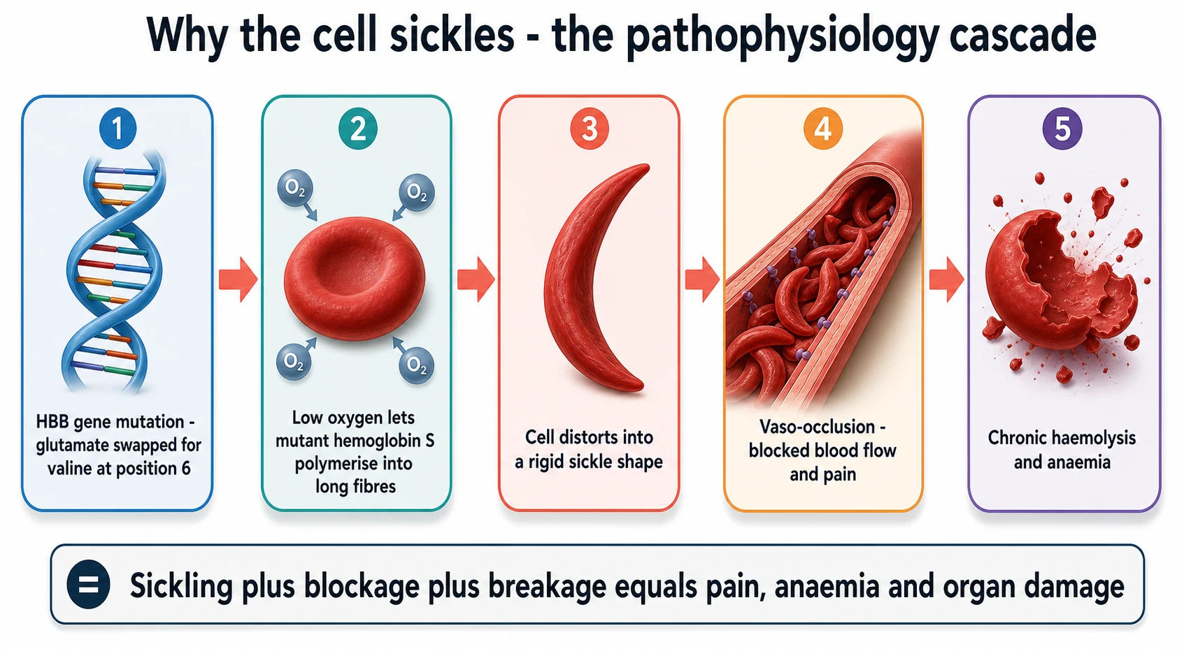 A clean scientific causal schematic on a white background. Five connected boxes flow left to right, joined by coral arrows. Box one shows an HBB gene mutation with the caption glutamate swapped for valine at position six. Box two shows a deoxygenated red cell with the caption low oxygen lets mutant haemoglobin S polymerise into long fibres. Box three shows a crescent banana-shaped sickled red cell with the caption the cell distorts into a rigid sickle shape. Box four shows a blocked blood vessel with the caption vaso-occlusion, blocked blood flow and pain. Box five shows a bursting red cell with the caption chronic haemolysis and anaemia. A summary bar reads sickling plus blockage plus breakage equals pain, anaemia and organ damage.