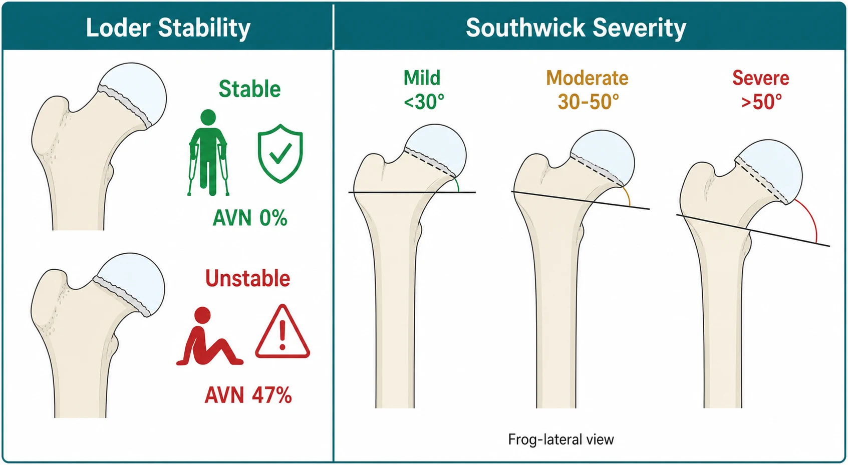 Diagnostic schematic with two panels side by side. Left panel titled Loder Stability shows two proximal femur cross-sections, the upper labelled Stable with a walking figure on crutches and a green shield and zero per cent avascular necrosis, the lower labelled Unstable with a figure unable to stand and a red warning triangle and forty-seven per cent avascular necrosis. Right panel titled Southwick Severity shows three frog-lateral femur diagrams at increasing posterior tilt angles, labelled Mild below thirty degrees in green, Moderate thirty to fifty degrees in amber, and Severe above fifty degrees in red, with the epiphysis slipping progressively posteroinferiorly off the metaphysis