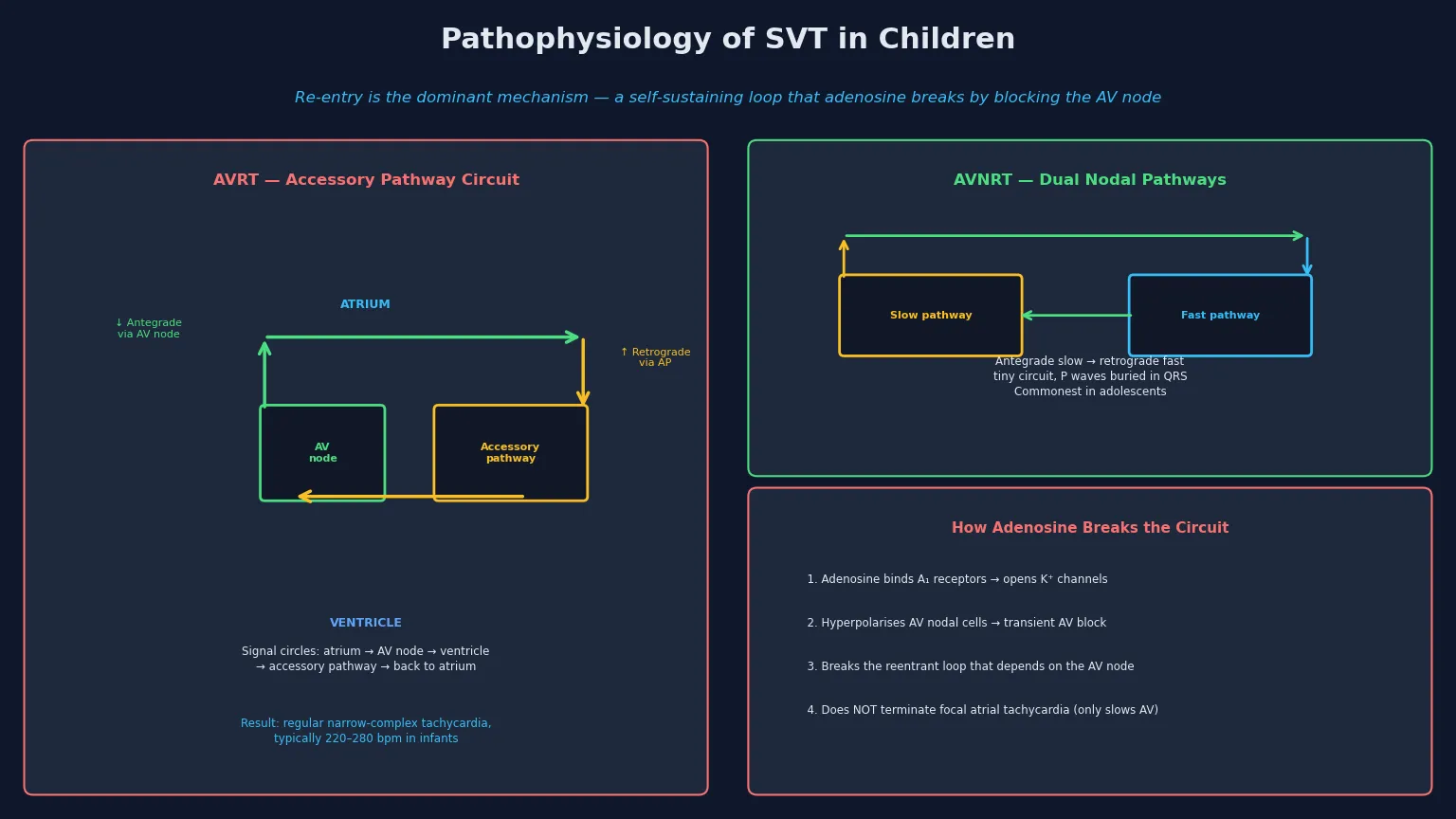 Educational mechanism schematic of paediatric supraventricular tachycardia showing the AVRT reentrant circuit (atrium, AV node, ventricle, accessory pathway), the AVNRT dual nodal pathway circuit, and how adenosine breaks reentry by transiently blocking the AV node