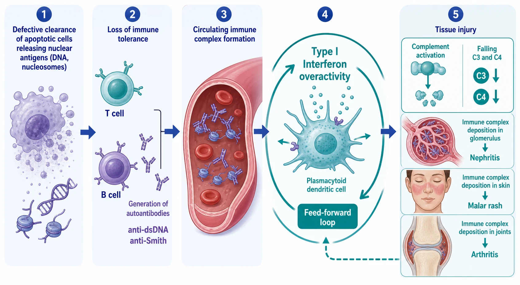 The pathophysiology cascade of systemic lupus erythematosus running left to right: defective clearance of apoptotic cells releasing nuclear antigens such as double-stranded DNA and nucleosomes, loss of immune tolerance with generation of anti-dsDNA and anti-Smith autoantibodies, circulating immune complex formation, a type I interferon amplification node driven by plasmacytoid dendritic cells, and tissue injury through complement activation with falling C3 and C4 and immune complex deposition in the glomerulus, skin, and joints producing nephritis, malar rash, and arthritis.