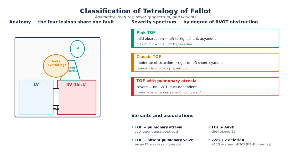 Educational schematic classifying tetralogy of Fallot showing the four anatomical features sharing one embryologic fault (anterocephalad deviation of the outlet septum), the severity spectrum from pink acyanotic TOF through classic cyanotic TOF to TOF with pulmonary atresia, and the key variants including absent pulmonary valve, atrioventricular septal defect and 22q11.2 deletion