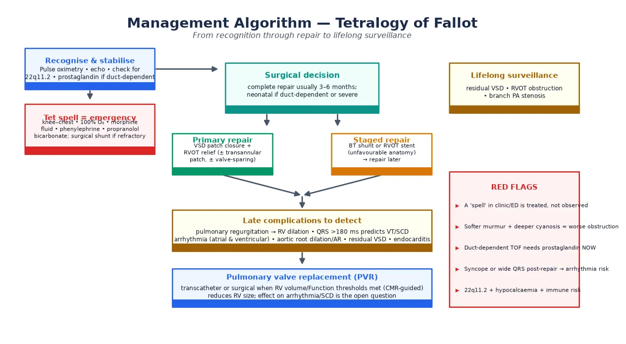 Educational management algorithm for tetralogy of Fallot from recognition and stabilisation through tet-spell management, the primary repair versus staged repair surgical decision, and lifelong surveillance for pulmonary regurgitation, arrhythmia and pulmonary valve replacement, with a red-flag panel