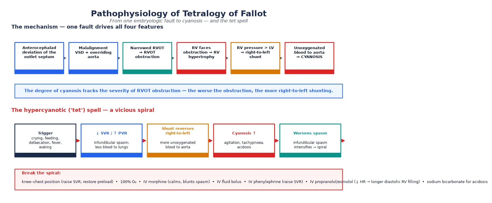 Educational mechanism schematic of tetralogy of Fallot showing the cascade from anterocephalad deviation of the outlet septum through the four features to right-to-left shunting and cyanosis, and a second panel showing the vicious spiral of the hypercyanotic tet spell with its breaking manoeuvres