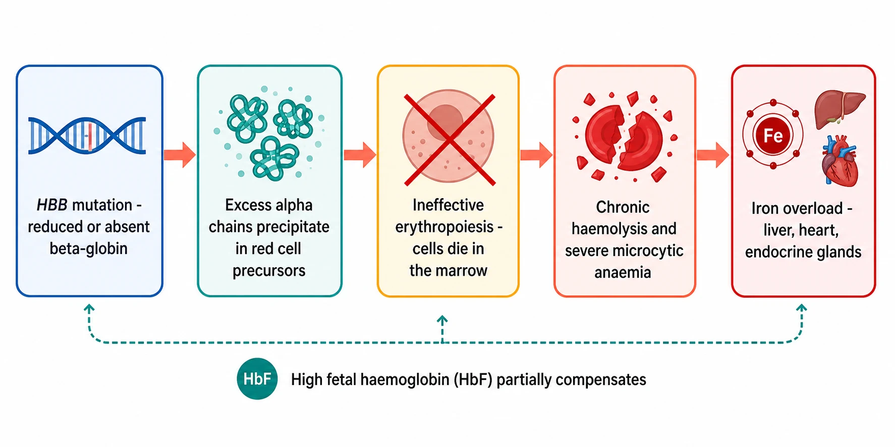 A clean scientific causal schematic on a white background. Five rounded boxes flow left to right joined by coral arrows. Box one blue shows an HBB gene icon with the text HBB mutation reduced or absent beta-globin. Box two teal shows unpaired alpha-globin chains clumping with the text excess alpha chains precipitate in red cell precursors. Box three amber shows a red cell precursor with a red X and the text ineffective erythropoiesis cells die in the marrow. Box four coral shows a shattered red blood cell with the text chronic haemolysis and severe microcytic anaemia. Box five red shows an iron atom beside liver and heart icons with the text iron overload liver heart endocrine glands. A note below reads high fetal haemoglobin partially compensates.