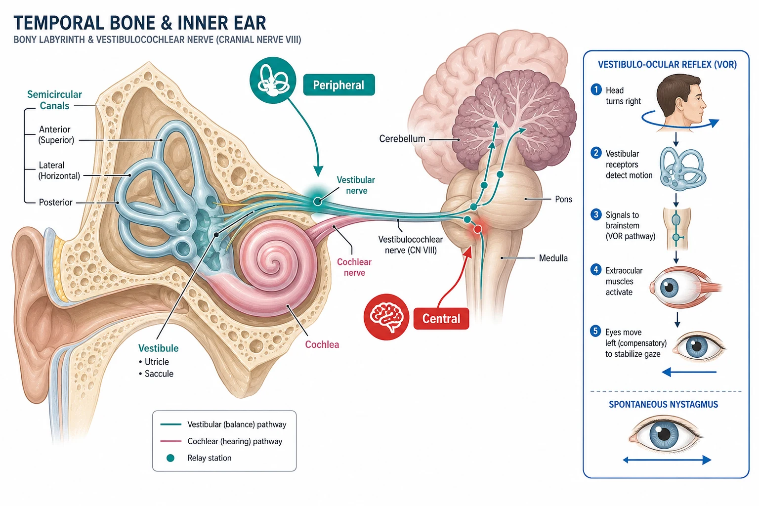 Educational anatomical schematic of the vestibular pathway showing the inner ear bony labyrinth with the three semicircular canals, vestibule, and cochlea, the vestibulocochlear nerve travelling to the brainstem and cerebellum, a peripheral lesion marker at the vestibular nerve for vestibular neuritis, a central lesion marker at the brainstem, and an inset of the vestibulo-ocular reflex with a stylised eye showing horizontal nystagmus