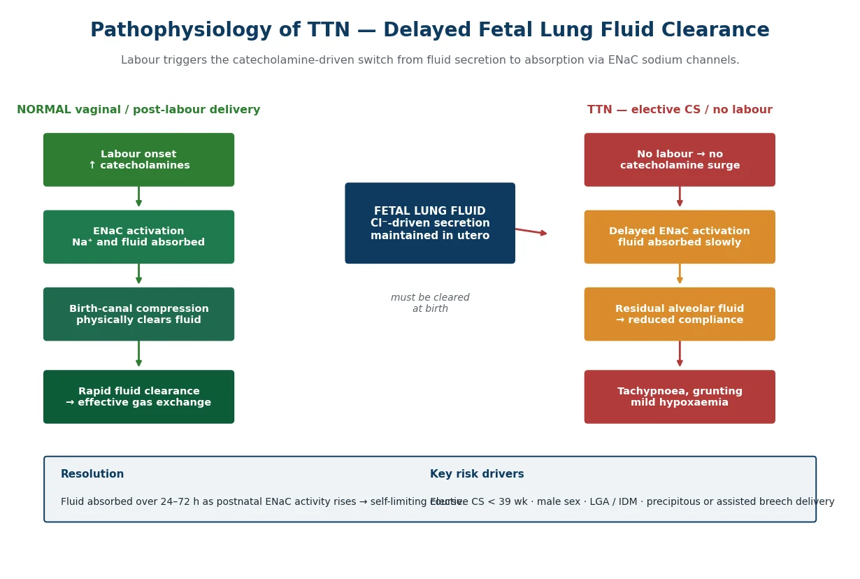 Diagram comparing normal vaginal delivery lung fluid clearance with delayed clearance after elective caesarean section