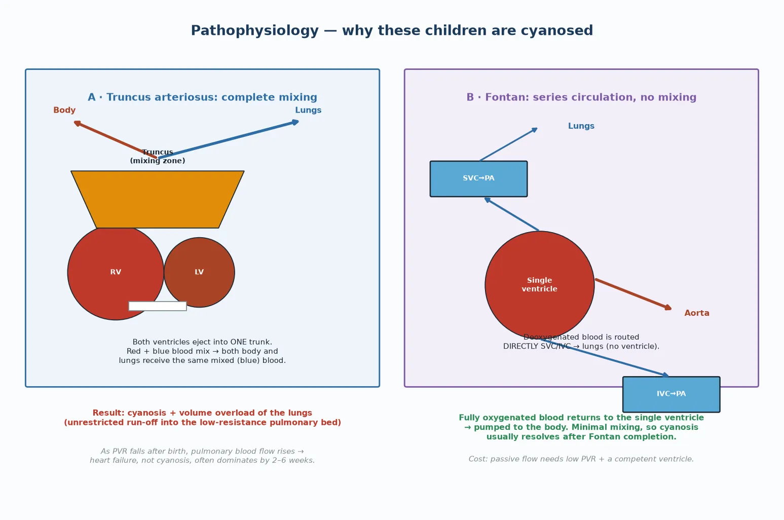 Two-panel pathophysiology figure. Panel A, truncus arteriosus. The right and left ventricles both eject into a single truncal trunk through an obligatory ventricular septal defect, so red and blue blood mix completely. The mixed blood then passes both to the aorta for the body and to the pulmonary artery for the lungs, so the body and the lungs receive the same mixed, partially blue blood. As pulmonary vascular resistance falls after birth, an ever larger share of the mixed blood takes the low-resistance path into the lungs, causing pulmonary over-circulation and high-output heart failure. Panel B, the Fontan series circulation. Deoxygenated blood from the superior and inferior venae cavae is routed directly to the pulmonary arteries through the bidirectional Glenn and the Fontan connections, without passing through a ventricle. Fully oxygenated blood returns to the single functional ventricle, which pumps it to the aorta and the body. The circulations are now in series, with minimal mixing, so cyanosis usually resolves after Fontan completion; the cost is that pulmonary flow is passive and depends on low pulmonary vascular resistance and a competent ventricle.
