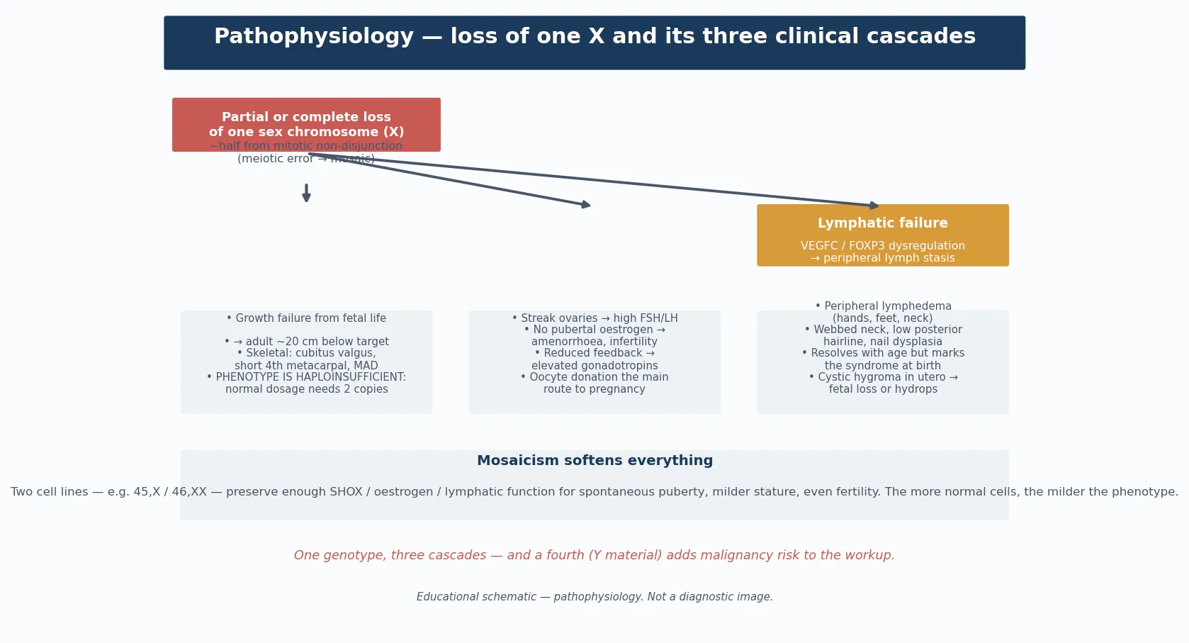 Pathophysiology cascade from complete or partial loss of one X chromosome, through haploinsufficiency of genes that escape X-inactivation, branching into three parallel streams — SHOX loss driving short stature and skeletal patterning, lymphogenic gene loss driving cystic hygroma and neck webbing, and gonadal gene loss driving streak ovaries and oestrogen deficiency — with a footer on the karyotype as the diagnostic confirmation