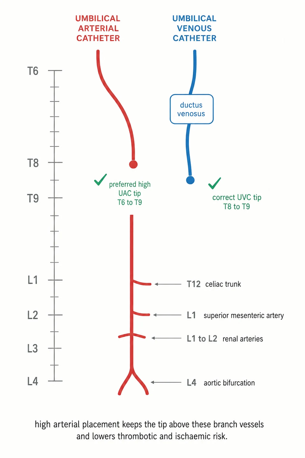 Educational sagittal anatomical schematic of a newborn torso showing the blue umbilical venous catheter path from umbilical vein through left portal vein and ductus venosus into the inferior vena cava with tip at T8 to T9, and the red umbilical arterial catheter path through internal iliac and common iliac arteries up the descending aorta with tip high at T6 to T9, annotated with the celiac trunk, superior mesenteric artery, renal arteries, and aortic bifurcation