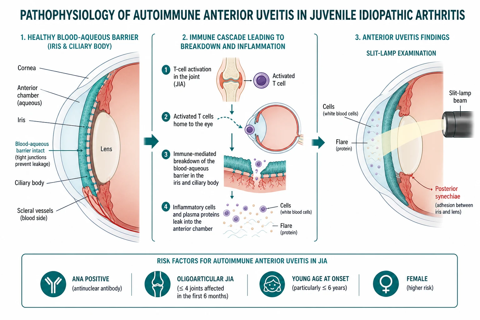 Left-to-right pathophysiology cascade: a healthy eye with an intact blood-aqueous barrier; T-cell mediated autoimmune activation breaking the barrier; protein and inflammatory cells leaking into the anterior chamber producing the slit-lamp findings of cells and flare; downstream structural complications drawn as posterior synechiae adhesions between iris and lens, band keratopathy calcium plaque on the cornea, cataract in the lens, and secondary glaucoma from trabecular meshway damage. Risk factors listed at the bottom: ANA positive, oligoarticular JIA, young age at onset, female sex.
