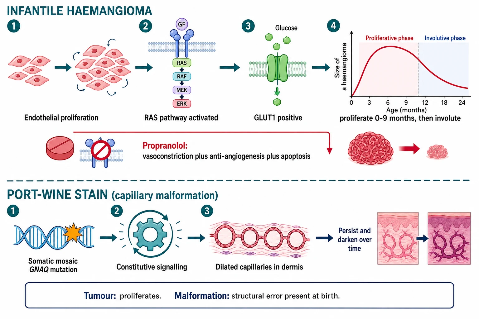 Two-lane pathophysiology cascade: top lane infantile haemangioma showing endothelial proliferation, RAS pathway activation, a GLUT1 positive transporter, and a growth graph that proliferates then involutes, with a beta-blocker icon labelled propranolol causing vasoconstriction and anti-angiogenesis and apoptosis that shrinks the lesion; bottom lane port-wine stain showing a somatic mosaic GNAQ mutation, constitutive signalling, and dilated thin-walled dermal capillaries that persist and darken over time