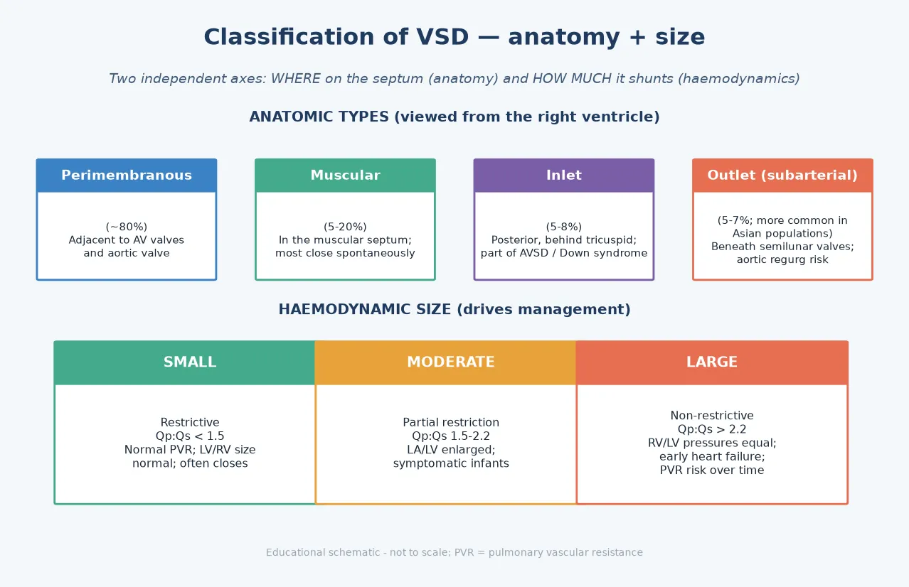 Classification of ventricular septal defect showing the four anatomic types (perimembranous, muscular, inlet, outlet) viewed from the right ventricle, and the three haemodynamic size groups (small, moderate, large) with their Qp:Qs ranges and chamber effects