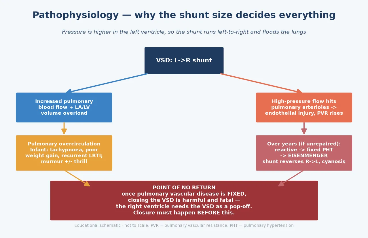 Pathophysiology of a ventricular septal defect showing the left-to-right shunt diverging into a left-heart volume load causing infant overcirculation on one side, and high-pressure flow raising pulmonary vascular resistance toward Eisenmenger syndrome on the other, with the point of no return marked