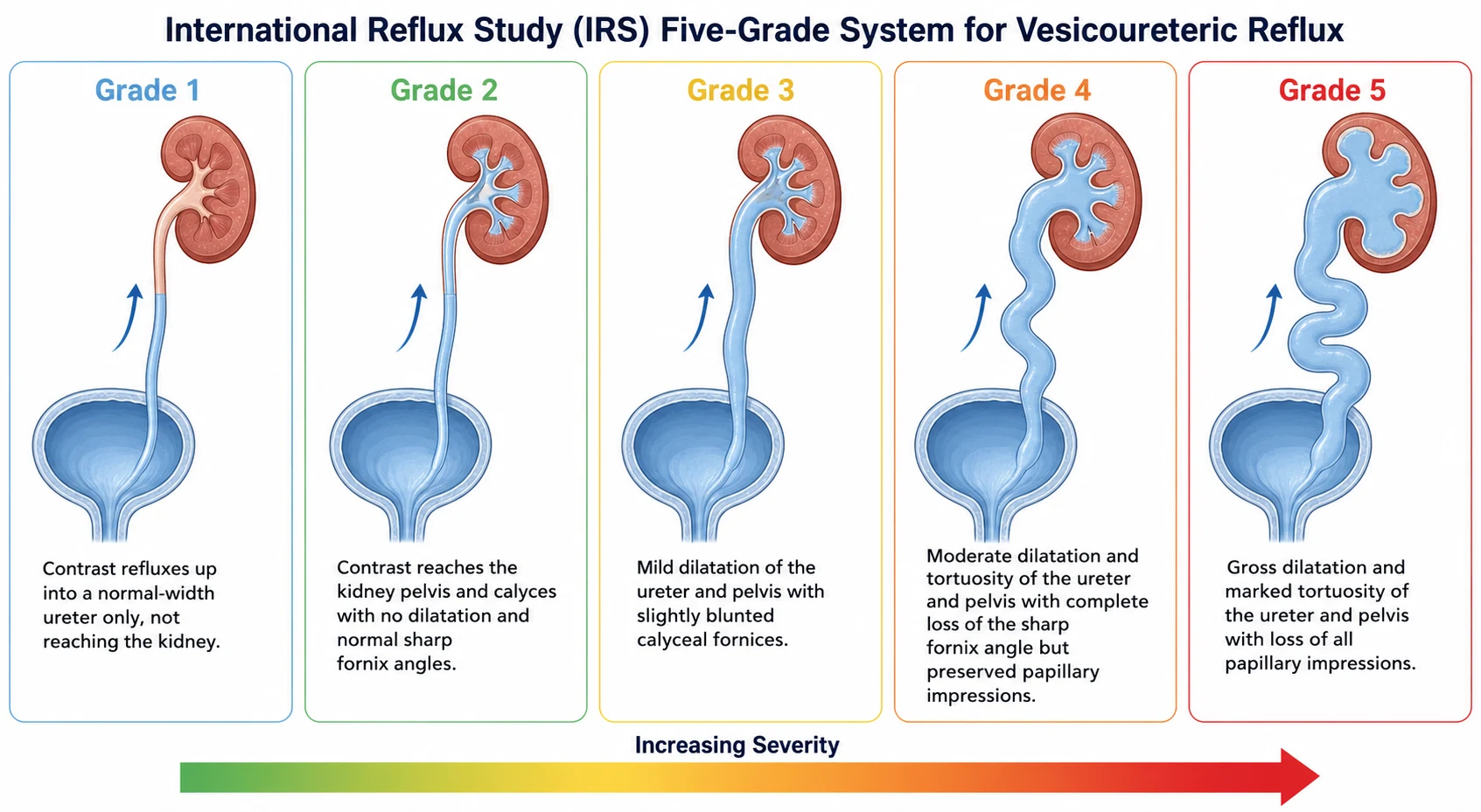 A medical-education infographic on a white background showing the International Reflux Study five-grade system for vesicoureteric reflux in five colour-coded panels from left to right, each containing a cross-section of the bladder in blue at the bottom with a kidney and ureter above it: Grade 1 in light blue showing contrast reflux into a non-dilated ureter only with an arrow pointing up the ureter, Grade 2 in green showing reflux into the renal pelvis and calyces with no dilatation and normal fornix angles, Grade 3 in yellow showing mild dilatation of the ureter and pelvis with slightly blunted calyceal fornices, Grade 4 in orange showing moderate dilatation and tortuosity of the ureter with complete loss of the sharp fornix angle but preserved papillary impressions, and Grade 5 in red showing gross dilatation and marked tortuosity of the ureter and pelvis with loss of all papillary impressions, with a legend at the bottom reading increasing severity from left to right
