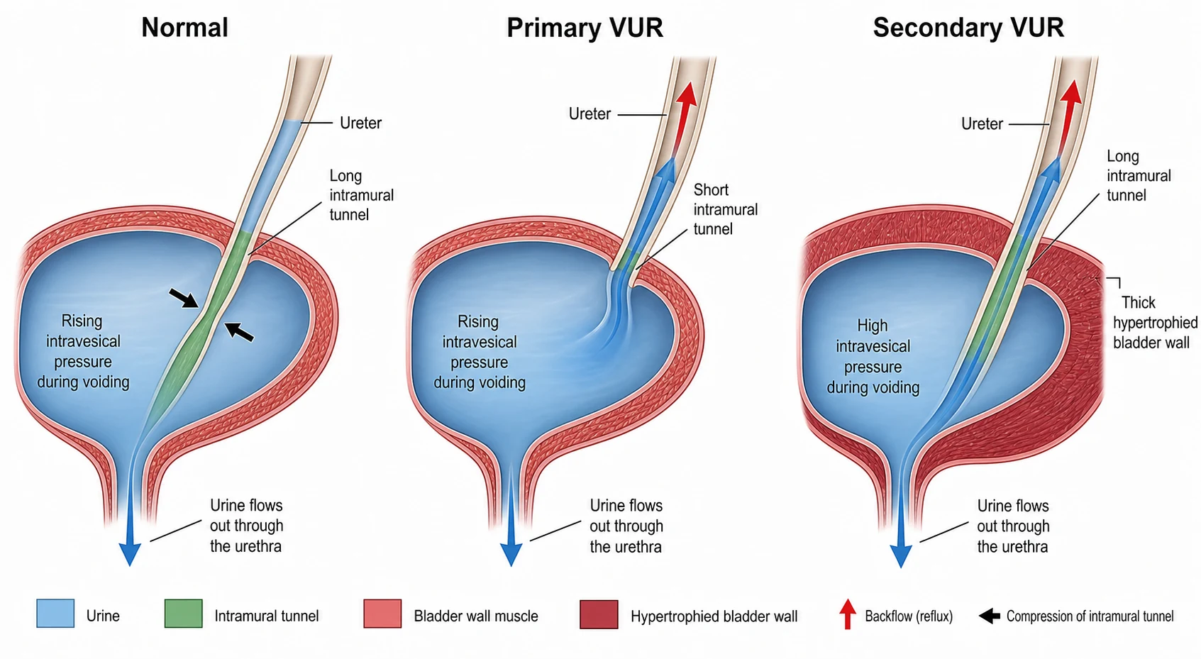 A scientific schematic on a white background showing the ureterovesical junction mechanism in three panels from left to right: the first panel labelled Normal shows a blue bladder cross-section at the bottom with a ureter entering at an oblique angle through a long intramural tunnel shown as a green arrow passing through the bladder wall muscle in red, creating a flap-valve mechanism where the rising intravesical pressure during voiding compresses the tunnel shut and prevents backflow, with a downward arrow showing urine flowing out through the urethra; the second panel labelled Primary VUR shows the same anatomy but with a markedly shortened intramural tunnel shown as a short green arrow that fails to compress during voiding, allowing blue contrast to flow upwards into the ureter with an upward red arrow; the third panel labelled Secondary VUR shows a normal tunnel length but a thick hypertrophied bladder wall in dark red generating high pressures from obstruction or neurogenic bladder, forcing urine backwards with an upward red arrow, with small molecular labels GDNF and RET and Pax2 noted at the top indicating the genetic basis