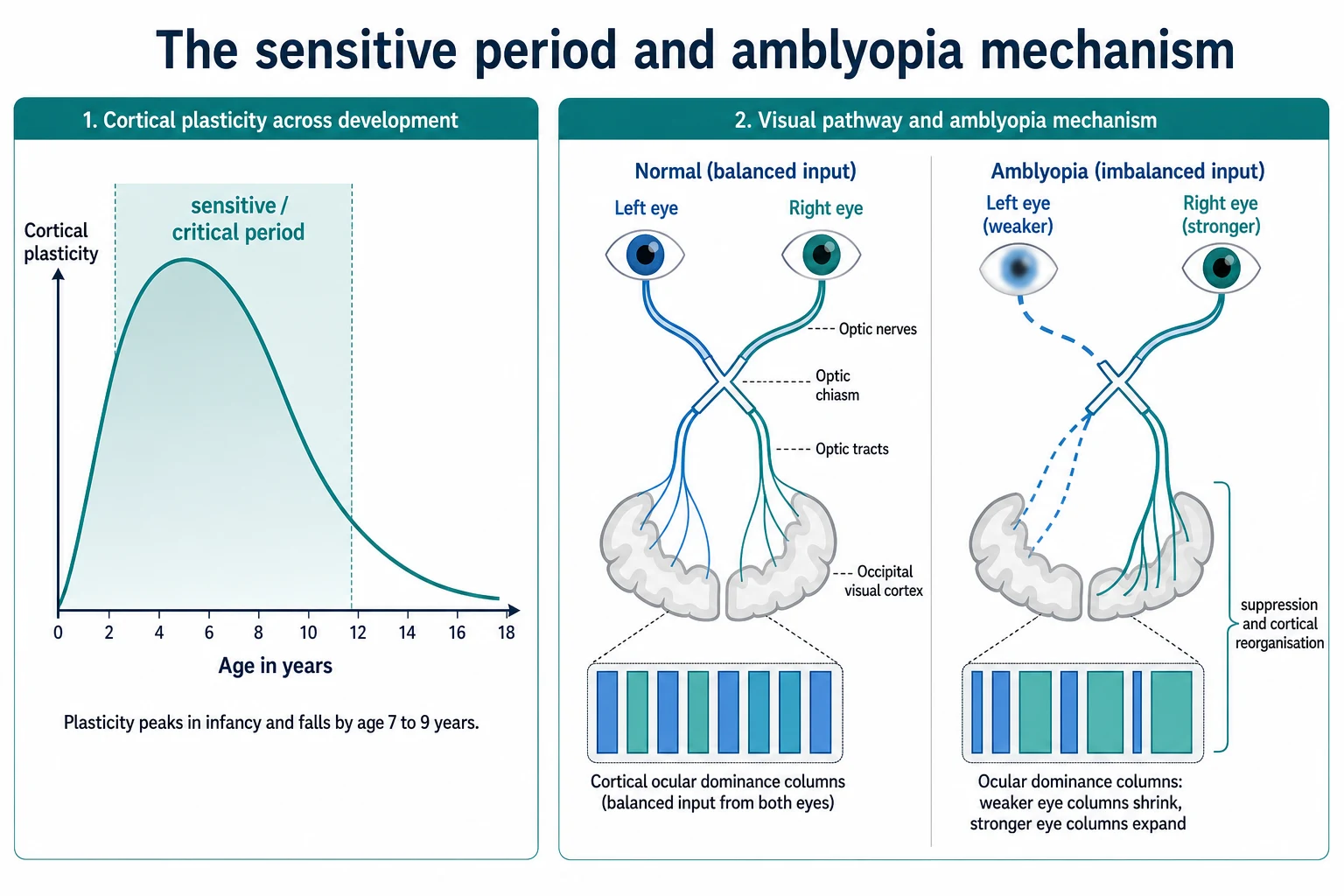 Educational neuroscience diagram with a bell-shaped cortical plasticity curve over the sensitive period to about seven to nine years, and a schematic of the visual pathway showing normal balanced input versus the suppressed shrunken cortical columns of the amblyopic eye