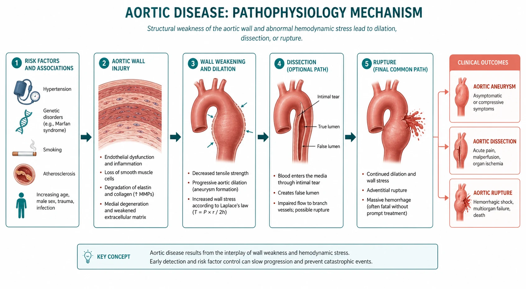 Pathophysiology mechanism diagram for Aortic Disease.