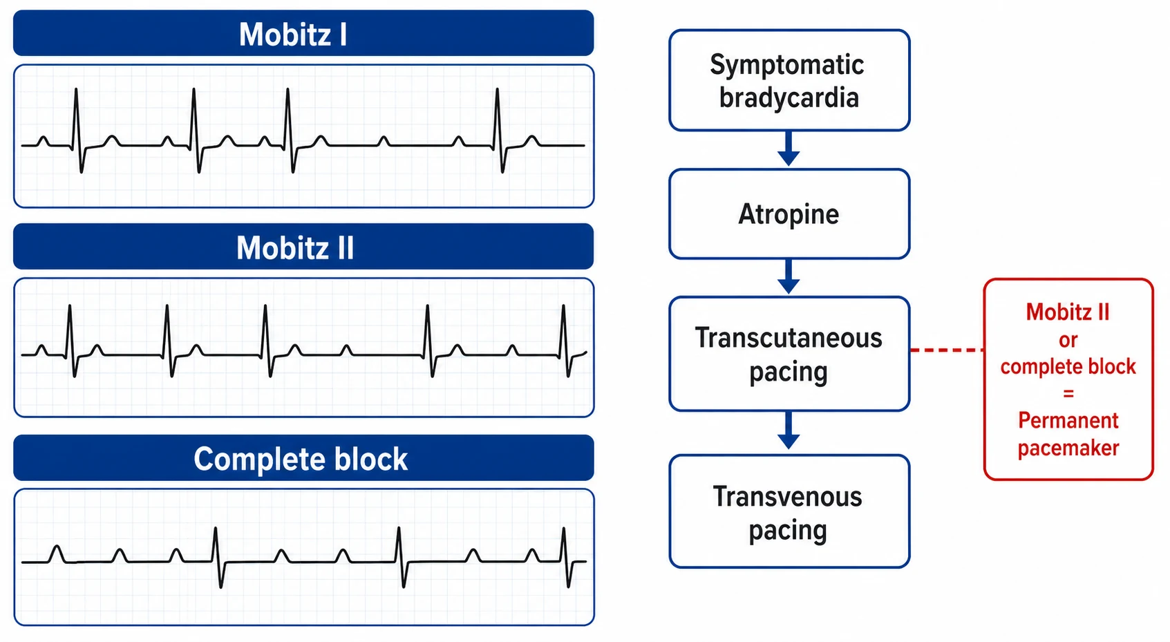 Mobitz I, Mobitz II and complete heart block ECG patterns with the pacing decision pathway