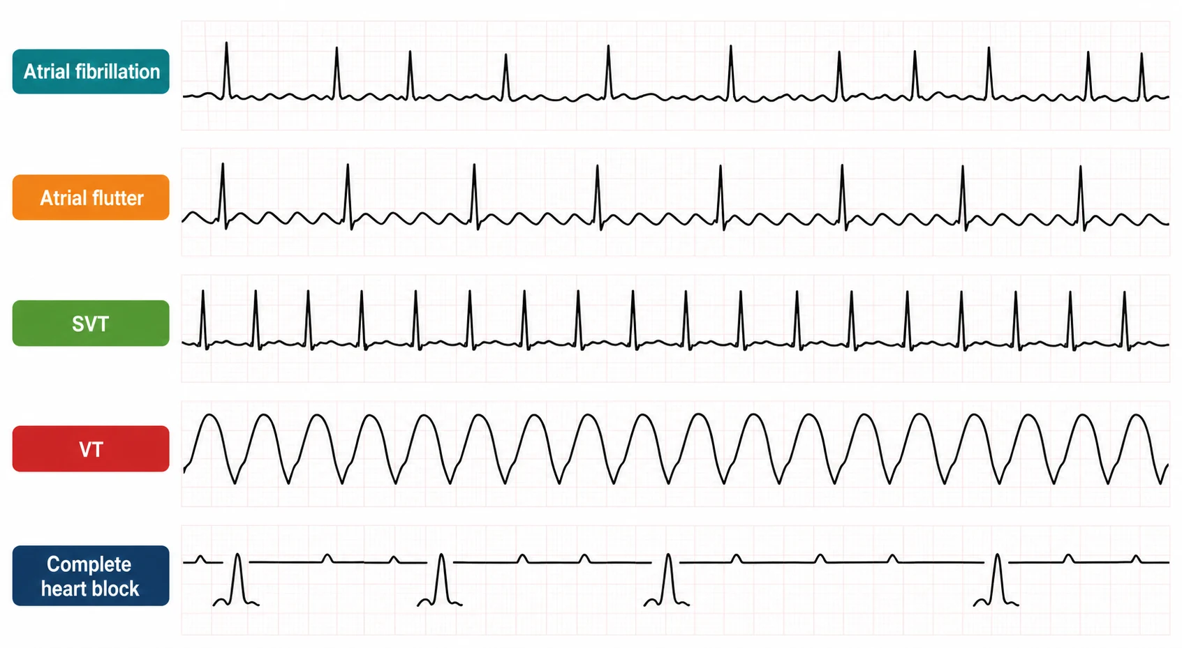 Five schematic ECG strips — atrial fibrillation, atrial flutter, SVT, VT and complete heart block
