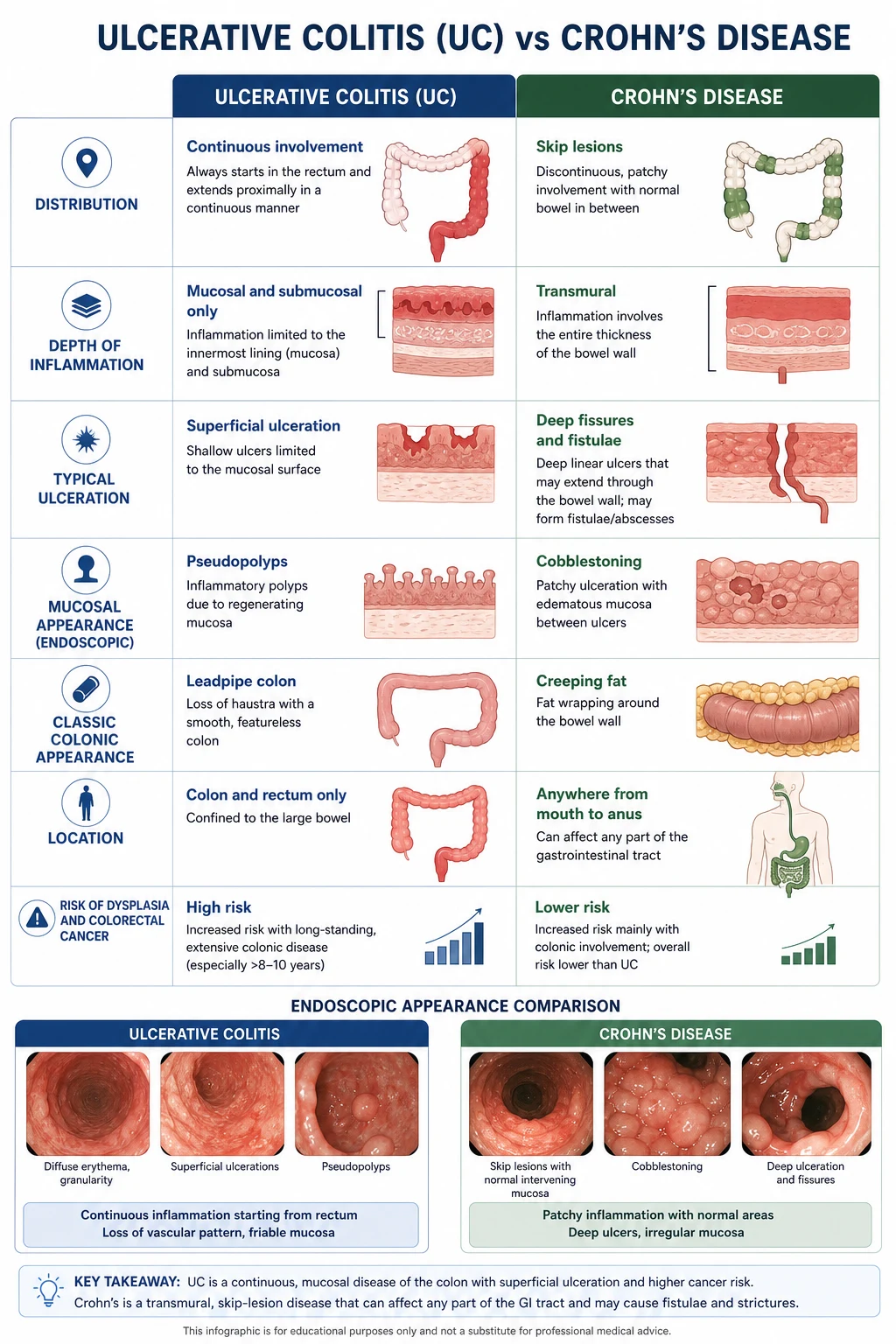 Side-by-side comparison table of ulcerative colitis versus Crohn's disease across distribution, histology, endoscopy, imaging and clinical features