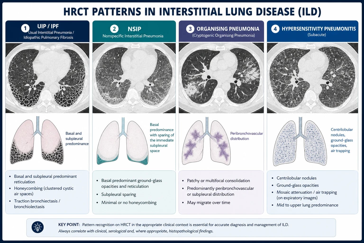 Management algorithm — MDT diagnosis, antifibrotic versus immunosuppressive therapy, transplant referral