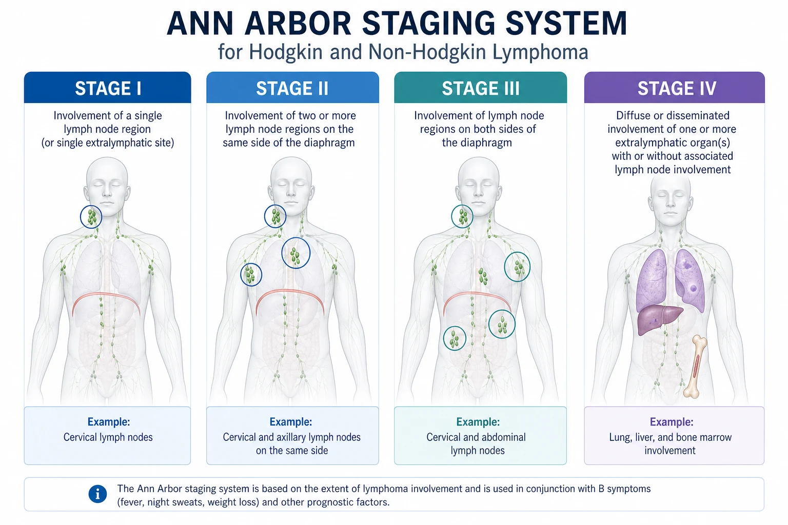 Ann Arbor staging of lymphoma with Cotswold and Lugano modifications — stage I to IV with nodal and extranodal schematics