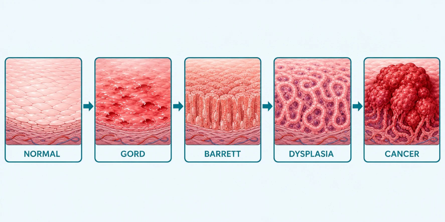 Progression from normal squamous mucosa through GORD, Barrett's metaplasia and dysplasia to adenocarcinoma